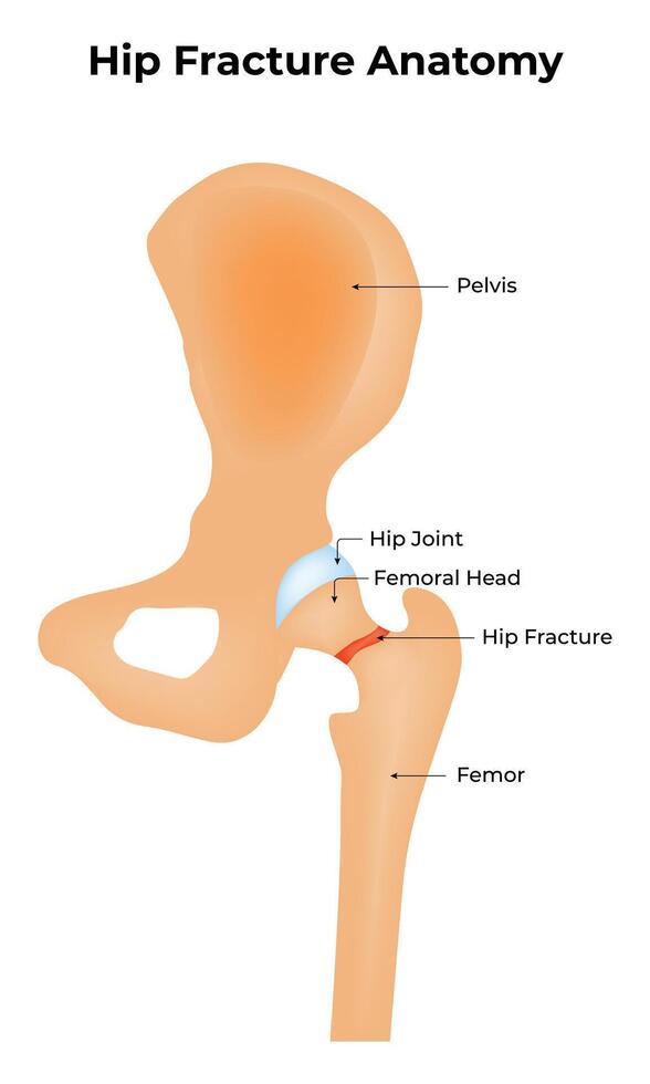 Hip Fracture Anatomy Science Design Illustration Diagram vector