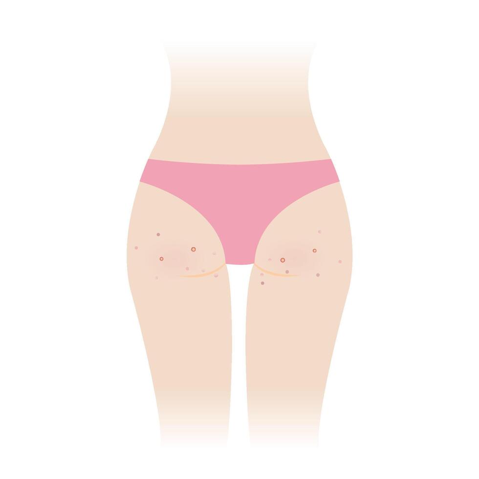 Acne on woman buttocks illustration isolated on white background. Pimples, comedone, papule, pustule, nodule and cyst on the bottom, hip, ass of woman body. Skin care and skin problem concept. vector