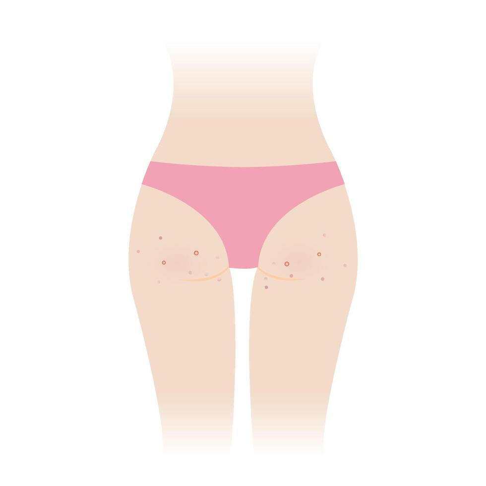 acné en mujer nalgas ilustración aislado en blanco antecedentes. espinillas, comedón, pápula, pústula, nódulo y quiste en el abajo, cadera, culo de mujer cuerpo. piel cuidado y piel problema concepto. vector