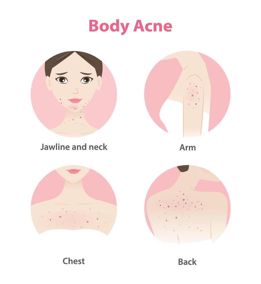 Acne on face and body woman icon set on white background. Pimples, blackheads, comedones, whiteheads, papule, pustule, nodule, cyst on jawline, neck, arm, chest and back. Skin problem concept. vector