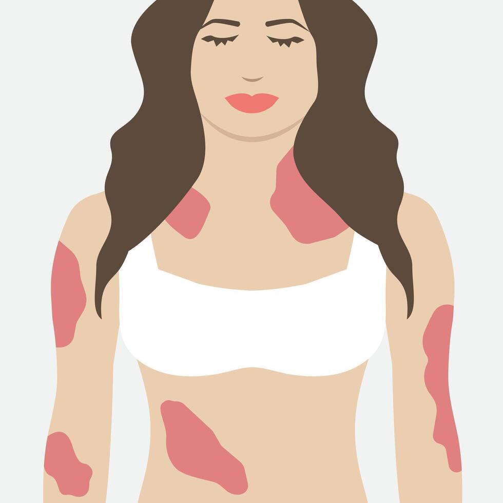 Woman with Psoriasis Red Skin Illness Illustration Design vector