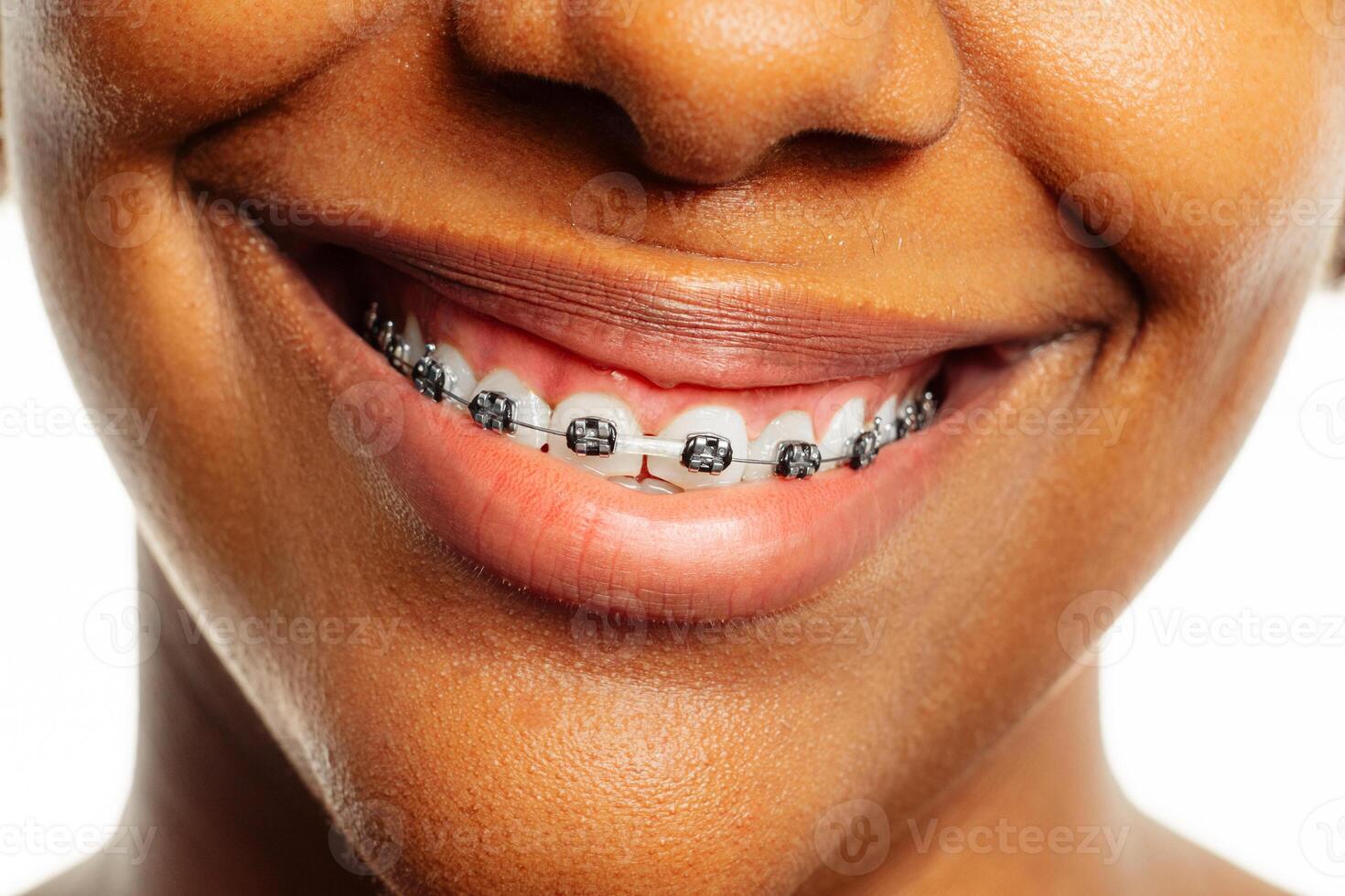 Healthy smile with braces over white background. photo