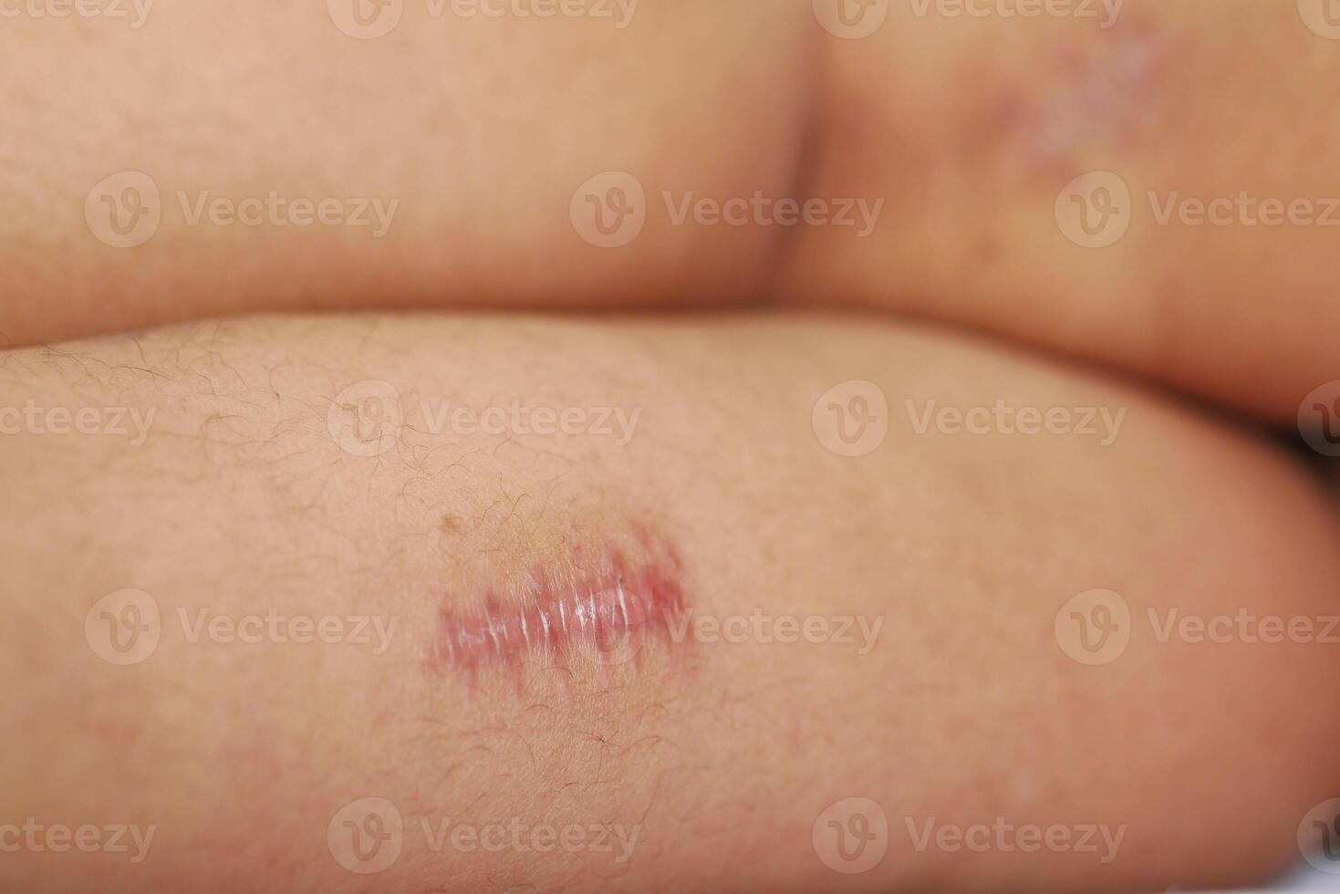 Stitched wound mark on a child foot. photo