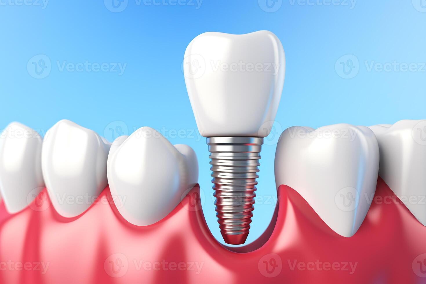 3D generated dental teeth implant.Health concept.Created with Generative AI technology. photo