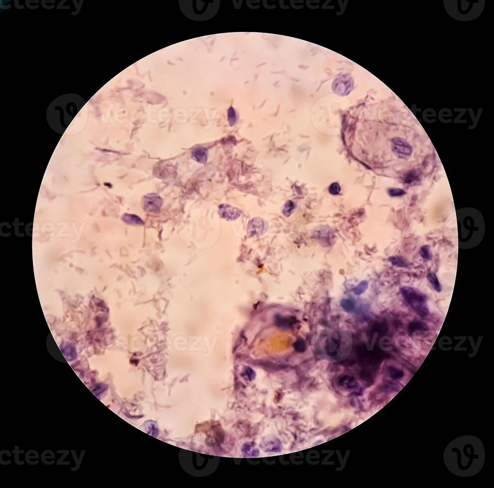 Trichomonas vaginalis is an anaerobic, flagellated protozoan parasite and the causative agent of trichomoniasis. photo