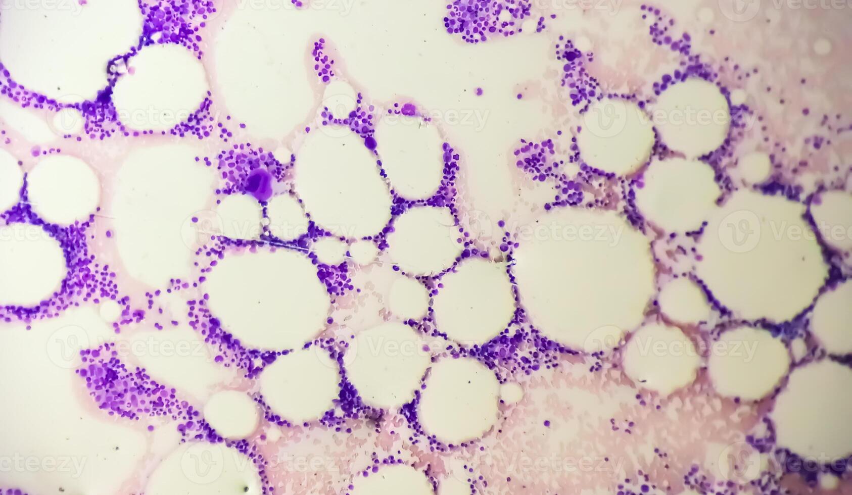 Photomicrograph Bone marrow study, Megakaryocytic Hyperplasia photo