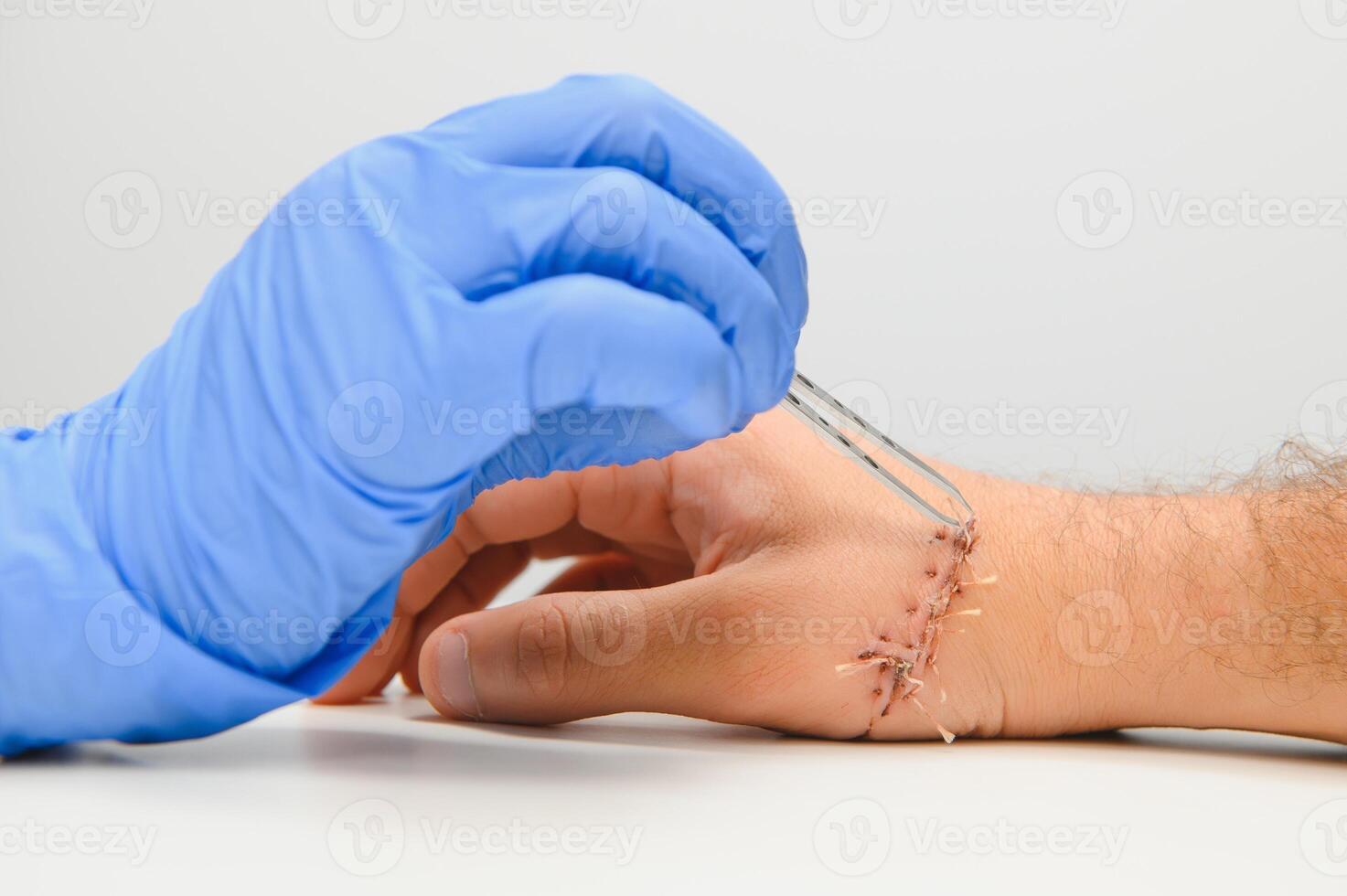 Suture wound on hand,Pain of accident concept photo