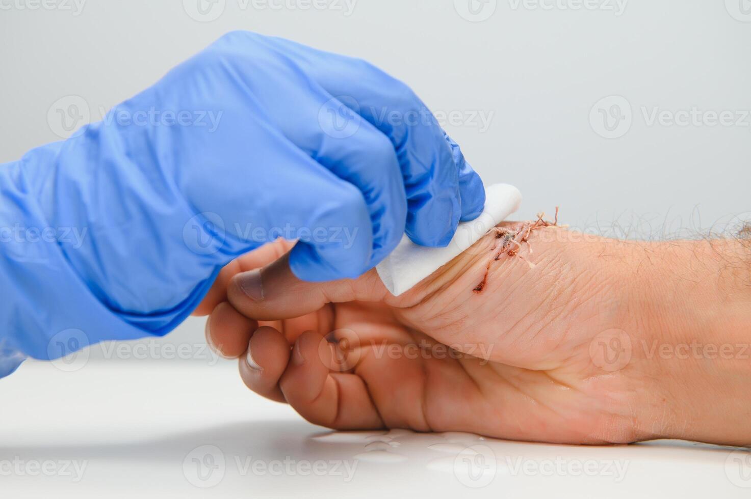 Suture wound on hand,Pain of accident concept photo