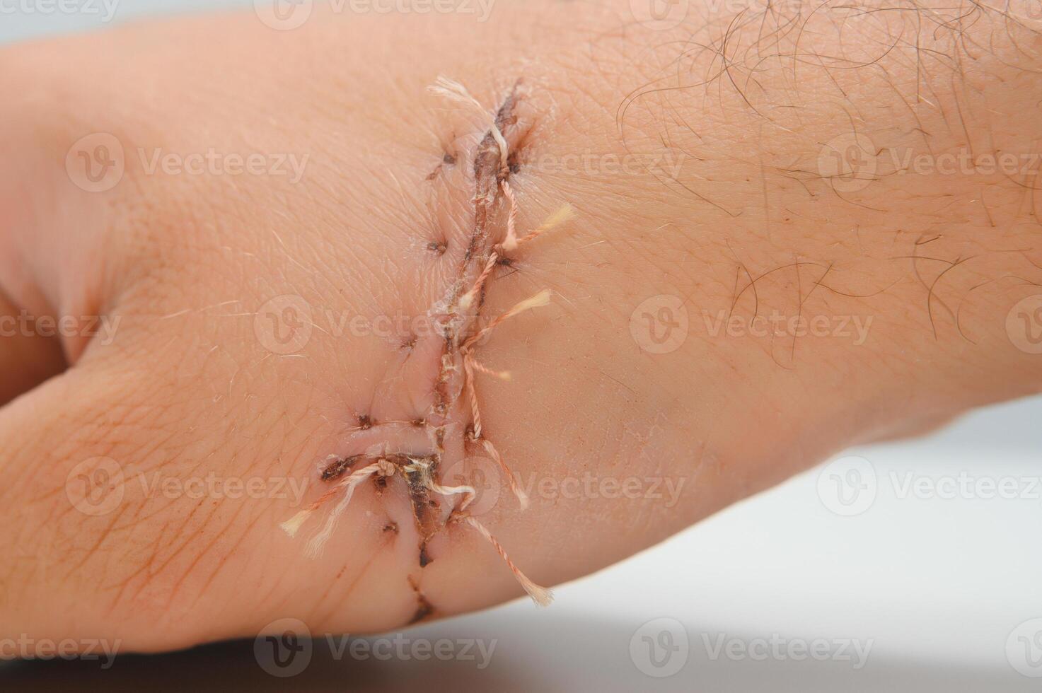 Suture wound on hand,Pain of accident concept photo