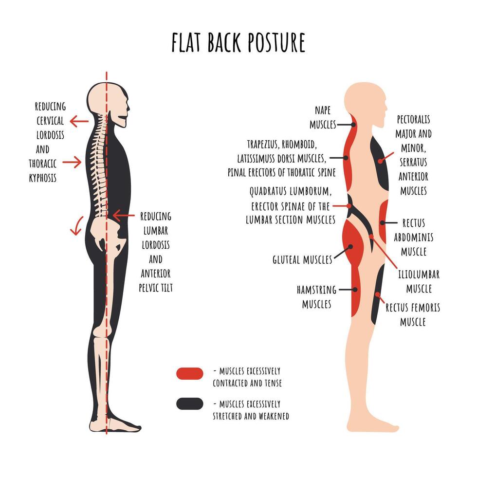 Flat back posture. The side view shows characteristic decrease natural curves of spine, pelvis rotation, stretched and weakened, shortened and tens muscles. vector
