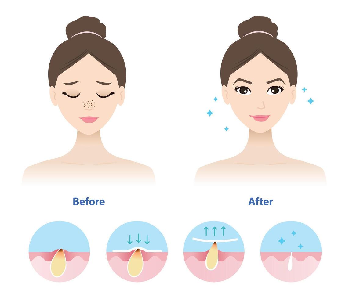 Comparison of woman face before and after blackhead removal illustration isolated on white background. Icon set of blackhead treatment process, apply, peel off, unclogging and tighten pore. vector