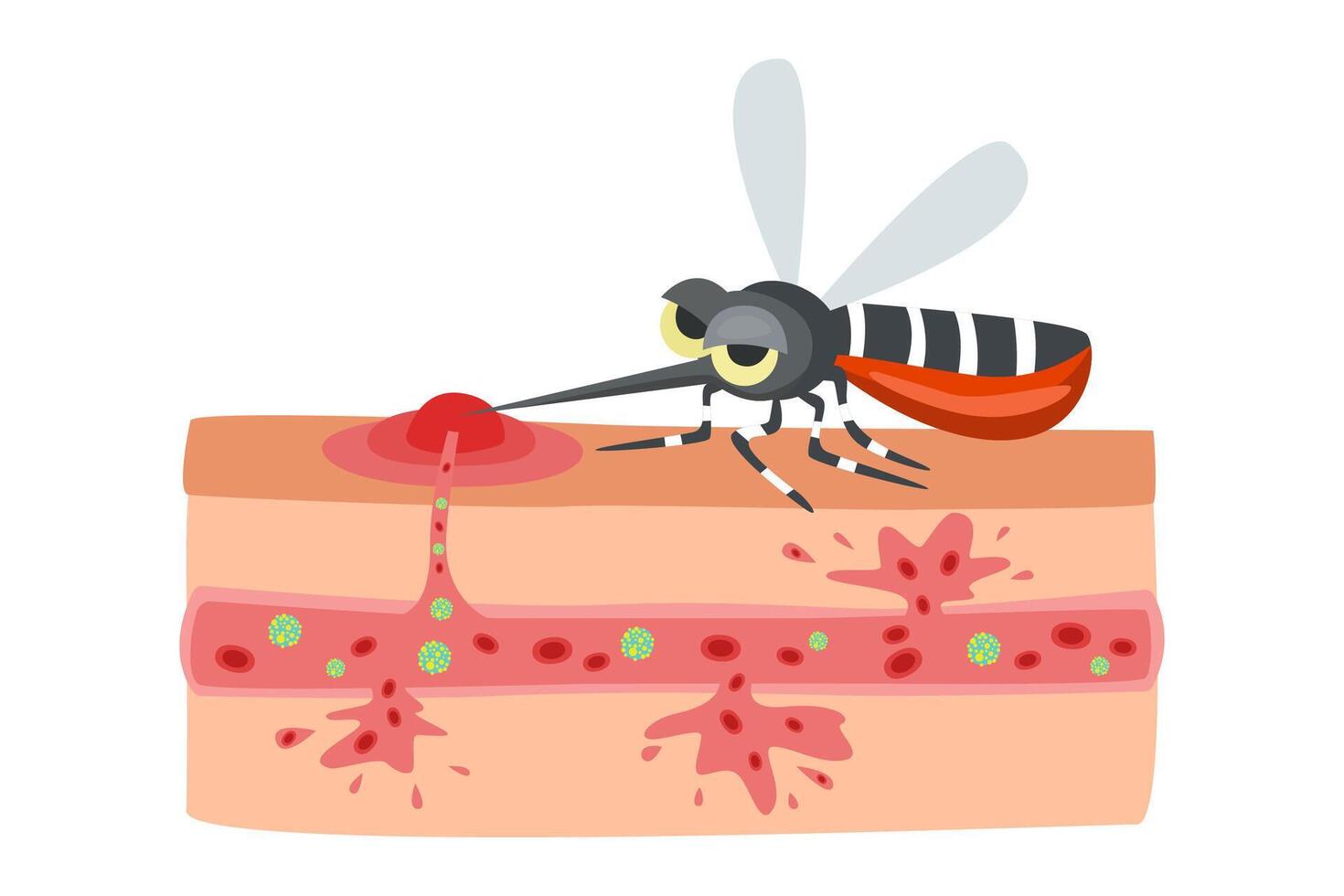 dengue hemorrhagic fever. mosquito carrier of dengue chikungunya zika malaria disease. vector