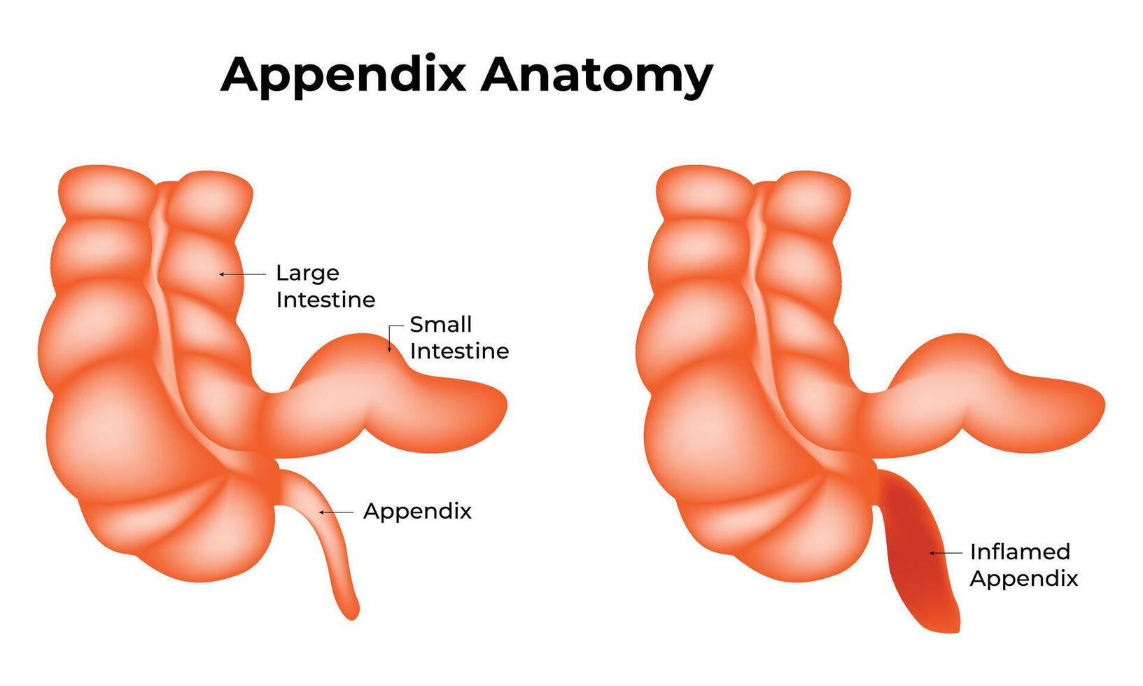 Appendix anatomy vector art icons and graphics for free download