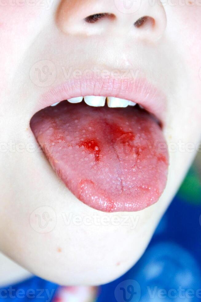 Close-up of lips, tongue, protrusion of blood. Child's bitten tongue. photo