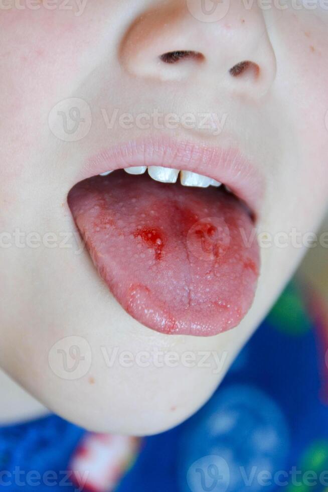 Close-up of lips, tongue, protrusion of blood. Child's bitten tongue. photo