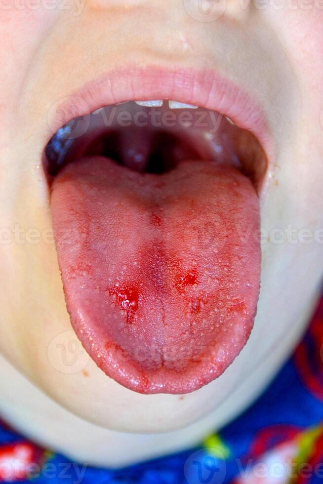 Close-up of lips, tongue, protrusion of blood. Child's bitten tongue. photo