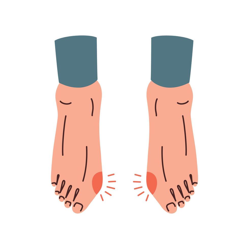 Feet with bunion, orthopedic condition, problem with feet, bone deformity, hallux valgus illustration, barefoot shoes brochure, high heeled narrow shoes health risks, redness and inflammation vector