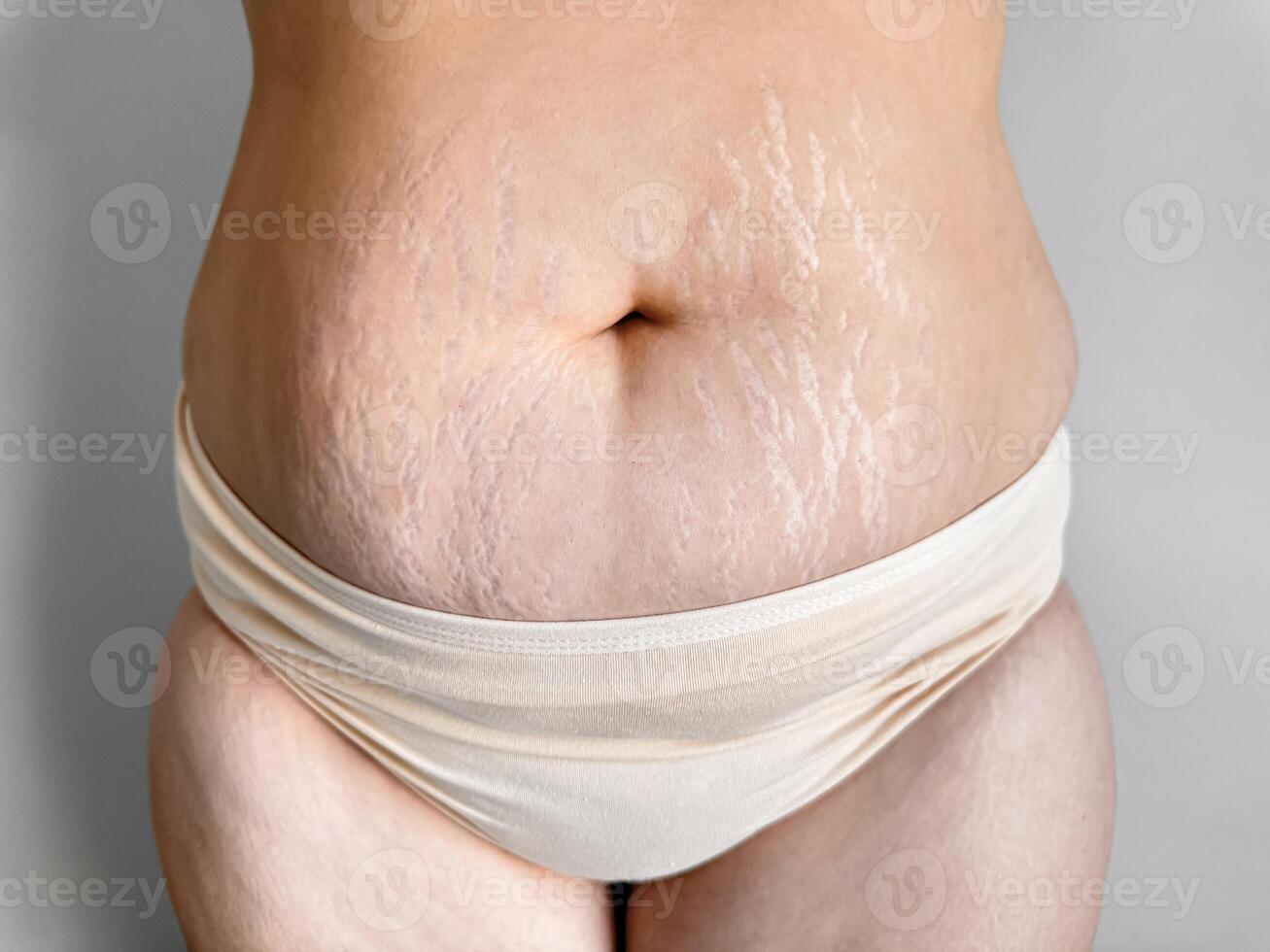 Womans midsection with stretch marks to celebrate real beauty, body positivity, and the natural changes after childbirth. The concept of self love and naturalness. photo