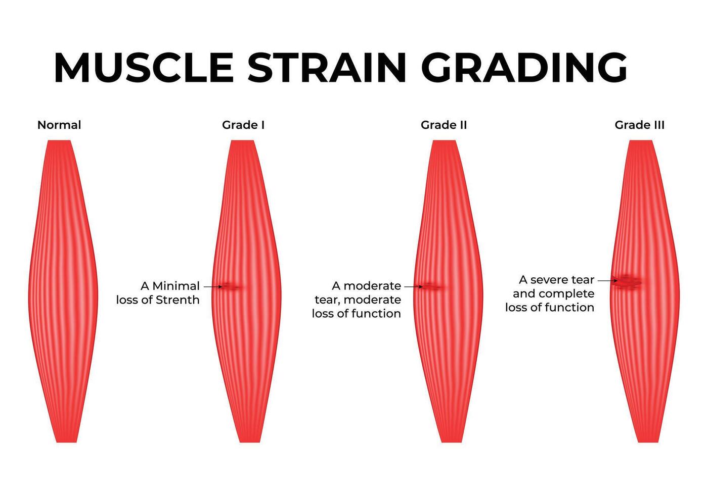 Muscle Strain Grading Science Design Illustration Diagram vector