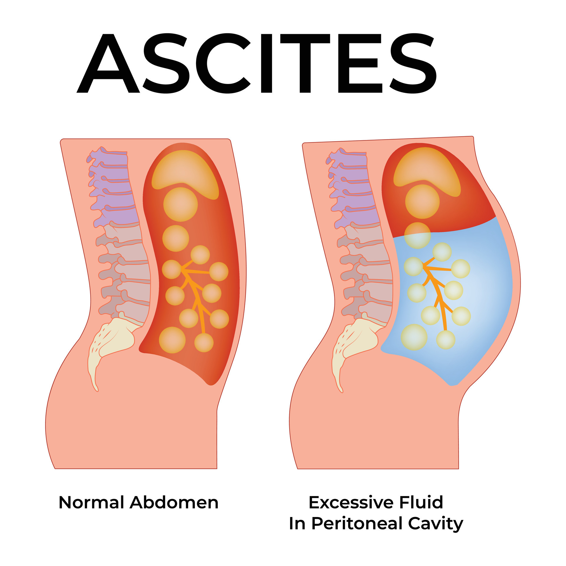 Ascites science design illustration diagram 45756129 vector art at vecteezy