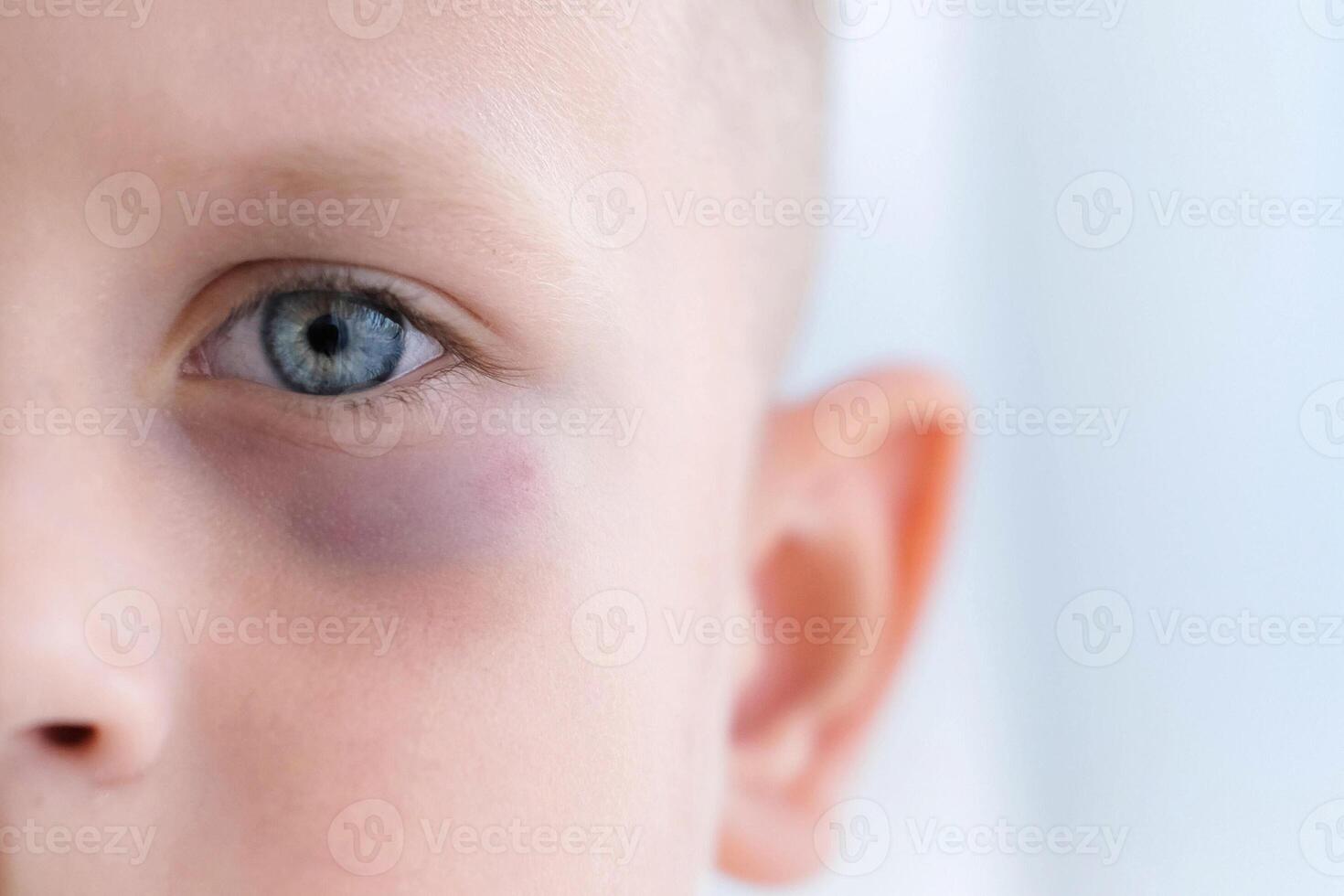Close-up of a child's eye with a bruise. A boy's face with a black eye. photo