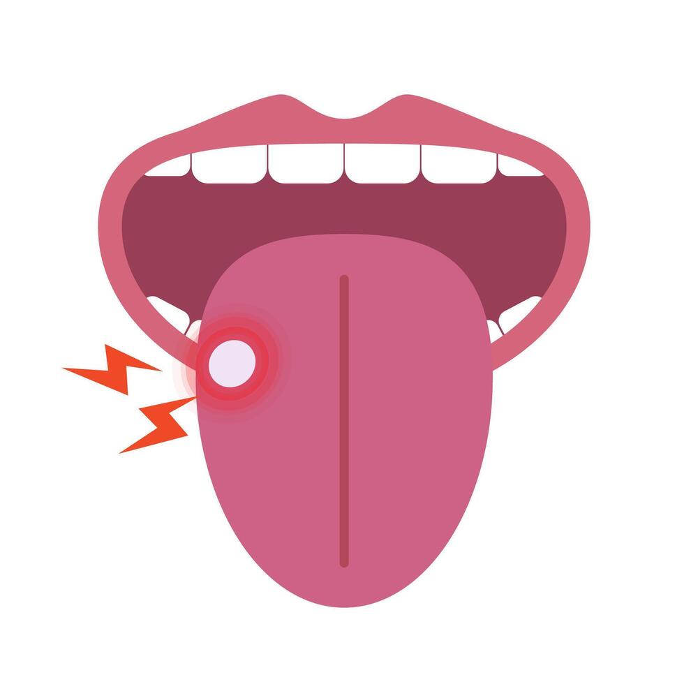 Mouth with canker sore. vector