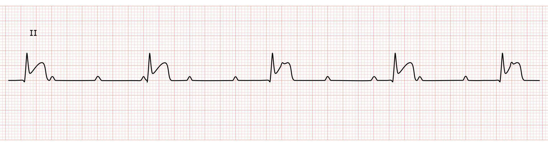 EKG Monitor in lead II Showing Complete heart block with STEMI at Inferior Wall vector