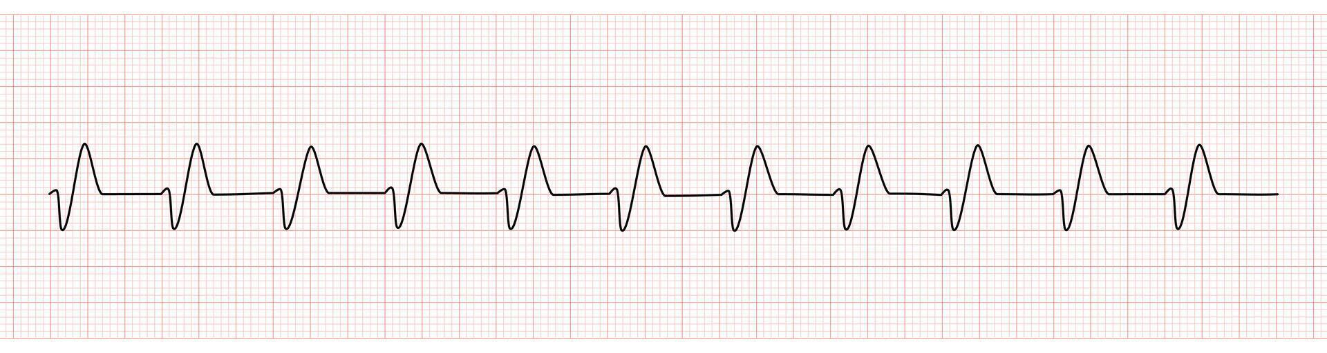 EKG Monitor Showing Wide QRS Complex From Hyperkalemia vector
