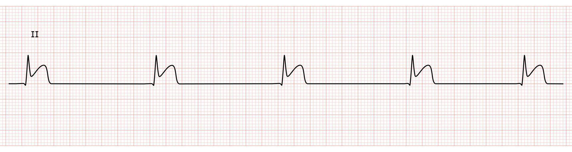 EKG Monitor in lead II Showing junctional Bradycardia with STEMI at Inferior Wall vector