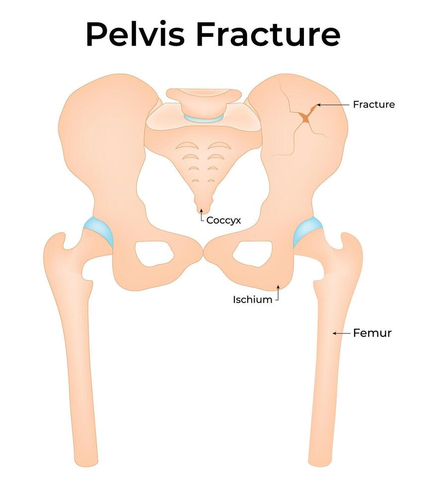 Pelvis Fracture Science Design Illustration Diagram vector