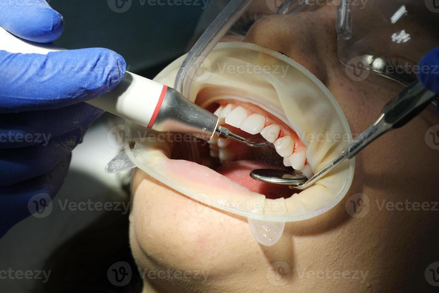 Dentist is doing intraoral scanning for woman before installing ceramic veneers and crowns. Orthodontist holds in his hand a manual 3D scanner for the jaw and mouth. Prosthodontics concept. photo