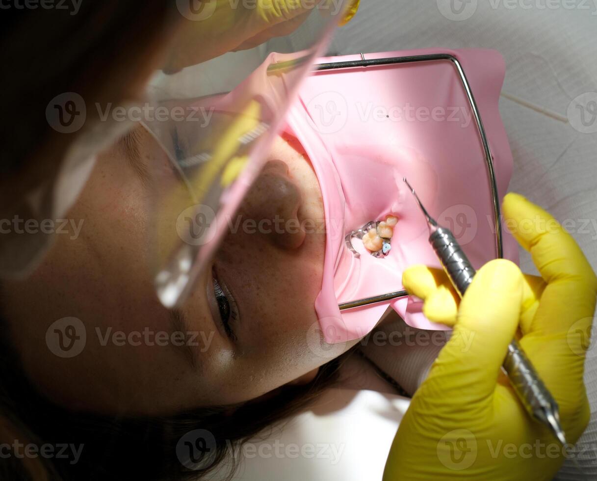 dentistry adolescence a doctor in yellow gloves fills a tooth of a young girl for a woman close-up in dentistry at the dentist drying the tooth with light new technologies modern clinic photo