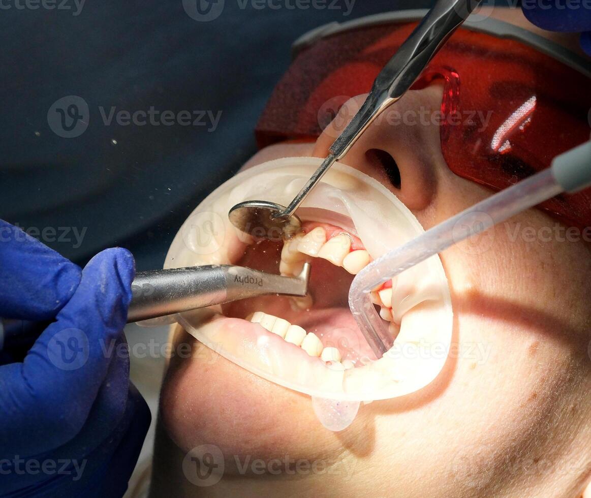 professional teeth cleaning in a dental clinic, removing stones and plaque, applying paint to teeth so that a layer of stones is visible, special newest devices in dentists, blue gloves, blue suits photo