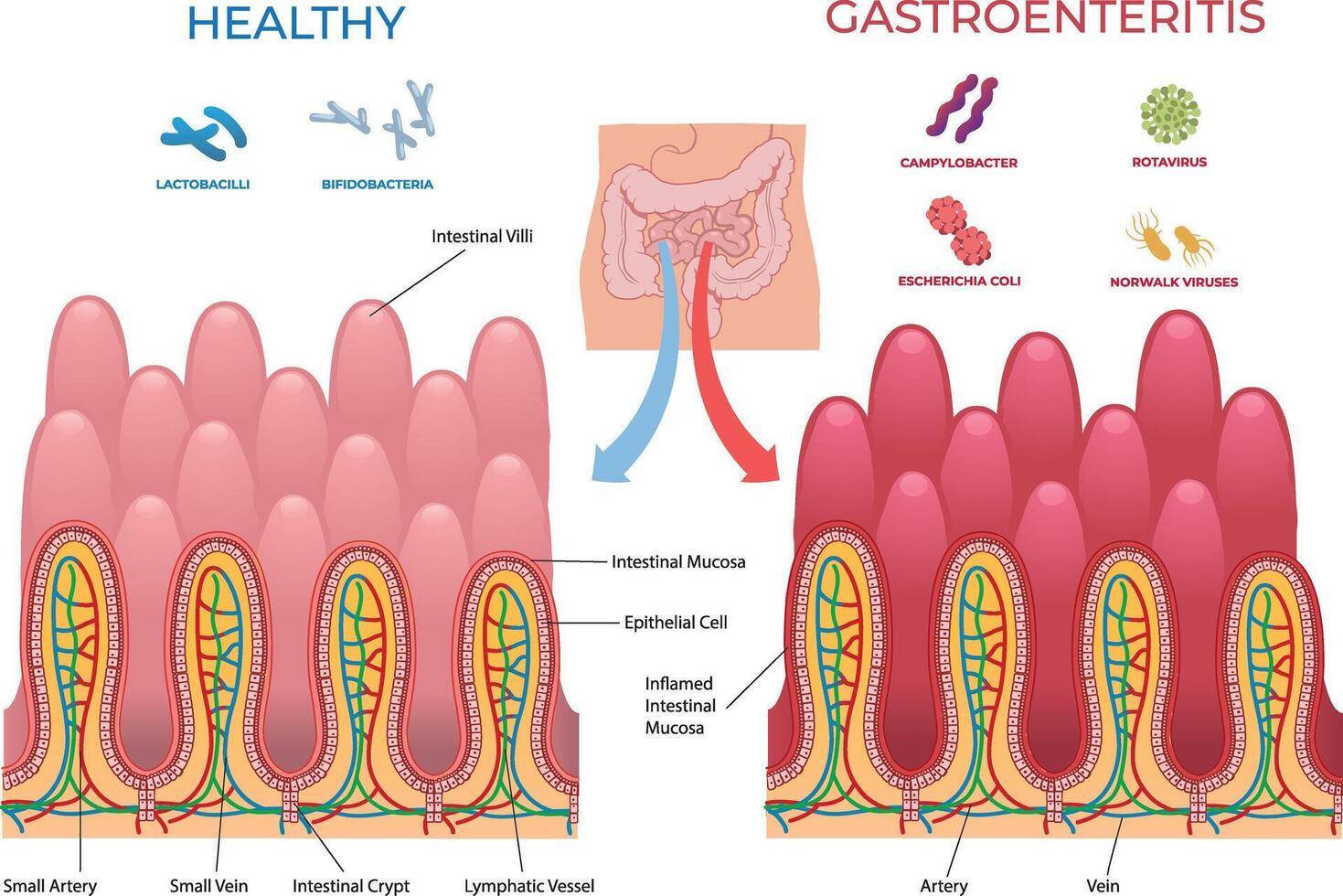 comparison illustration between healthy intestine and gastroenterintis vector