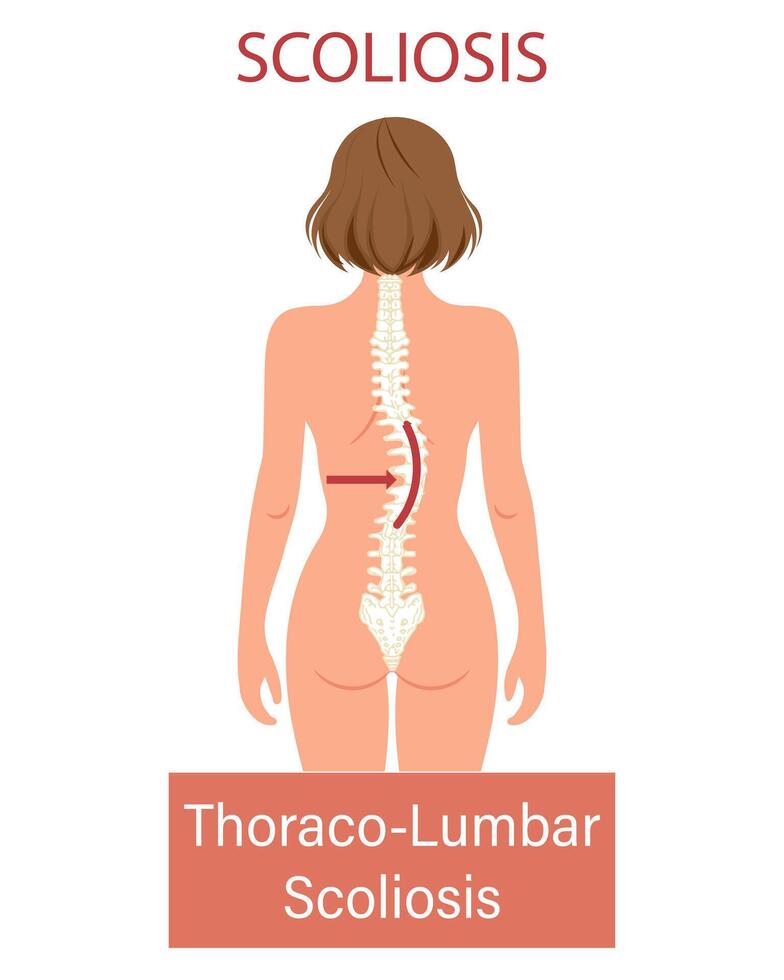 Scoliosis, a disease of the spine. Infographic banner with scoliosis of the human spine. Healthcare and medicine. Illustration vector
