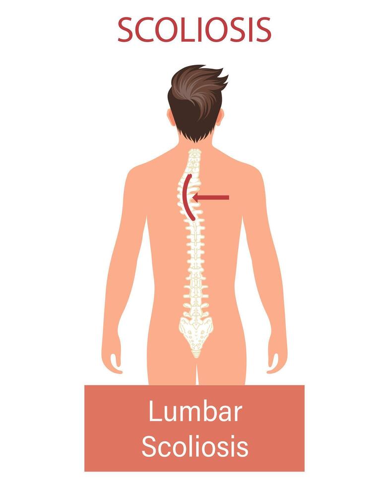 Scoliosis, a disease of the spine. Infographic banner with scoliosis of the human spine. Healthcare and medicine. Illustration vector
