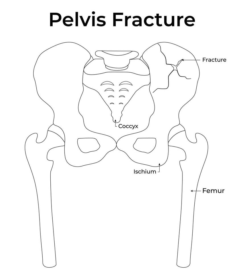 Pelvis Fracture Science Design Illustration Diagram vector