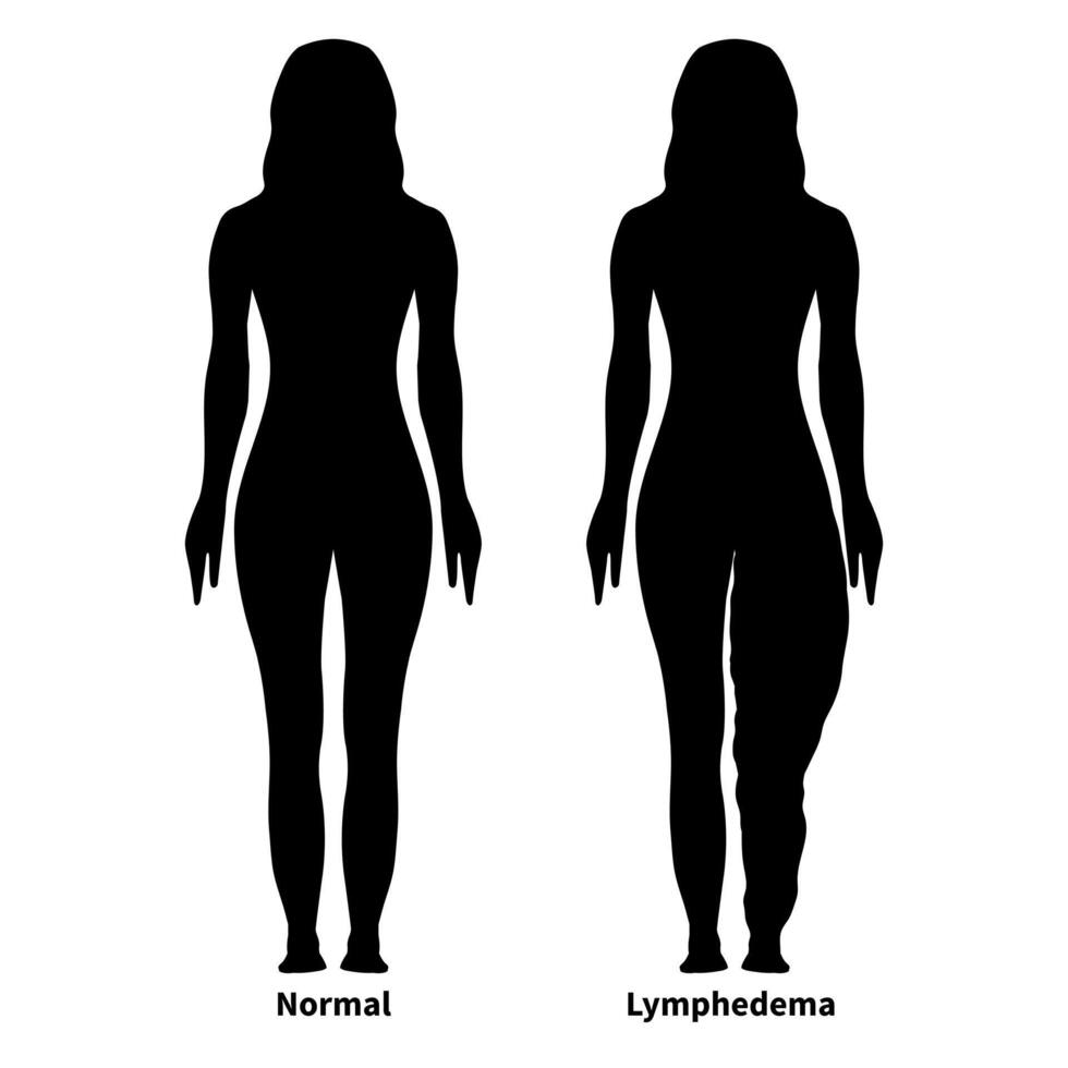Lymphedema Silhouette Illustration with Woman with Normal and Lipedema vector