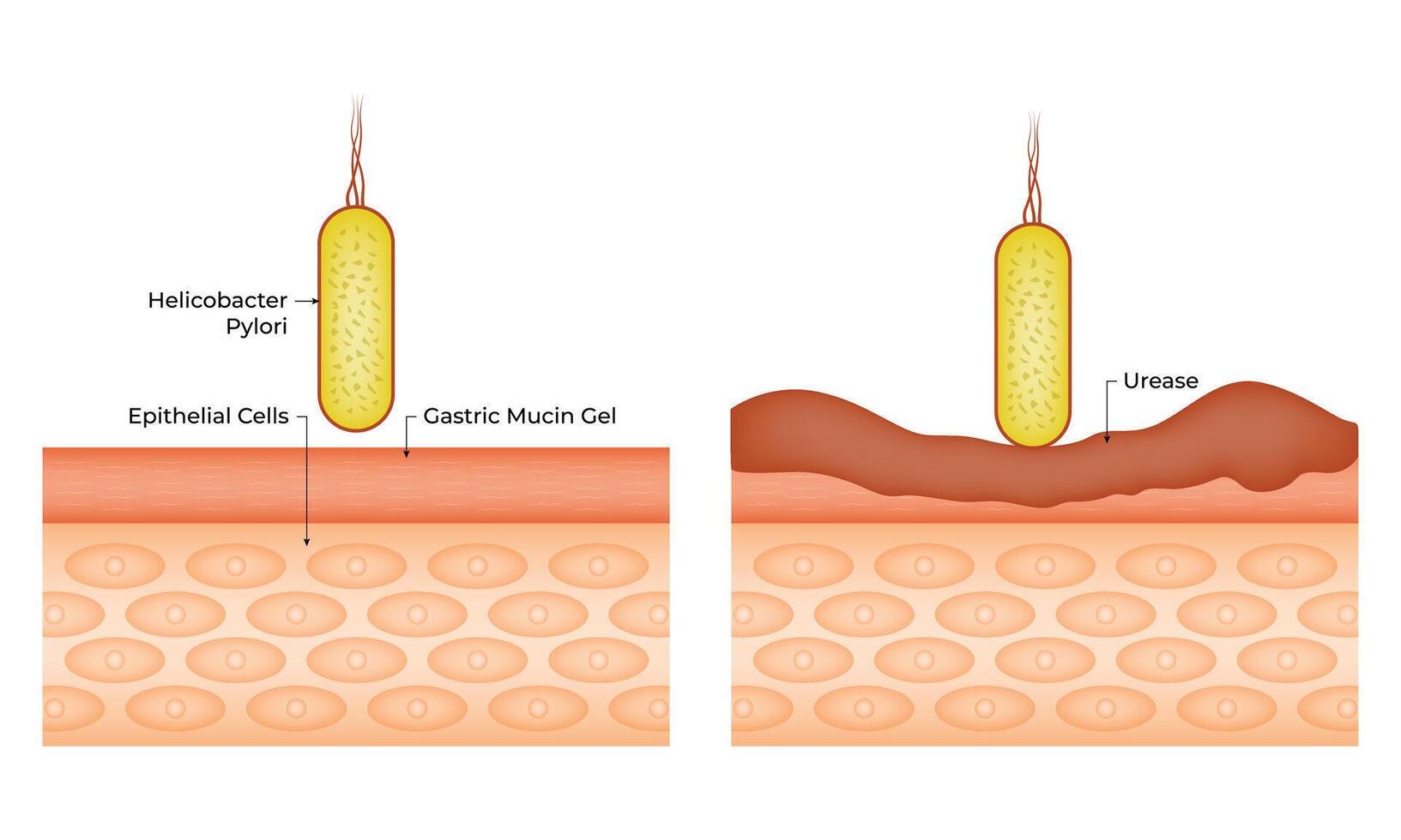 Helicobacter Pylori Epithelial Cells Design Illustration Diagram vector