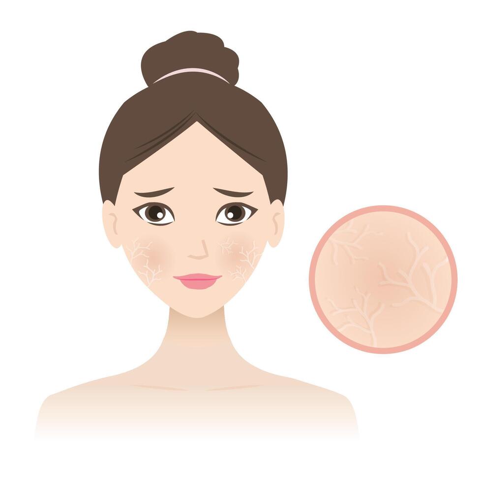 Woman with dehydrated skin face illustration isolated on white background. Dry skin patches, rough, scaly and itchy. Fine lines in the skin or a dull complexion. Skin care and beauty concept. vector