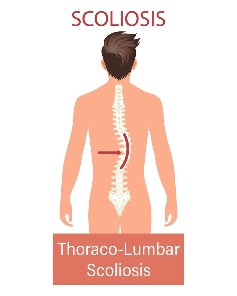 Scoliosis, a disease of the spine. Infographic banner with scoliosis of the human spine. Healthcare and medicine. Illustration vector