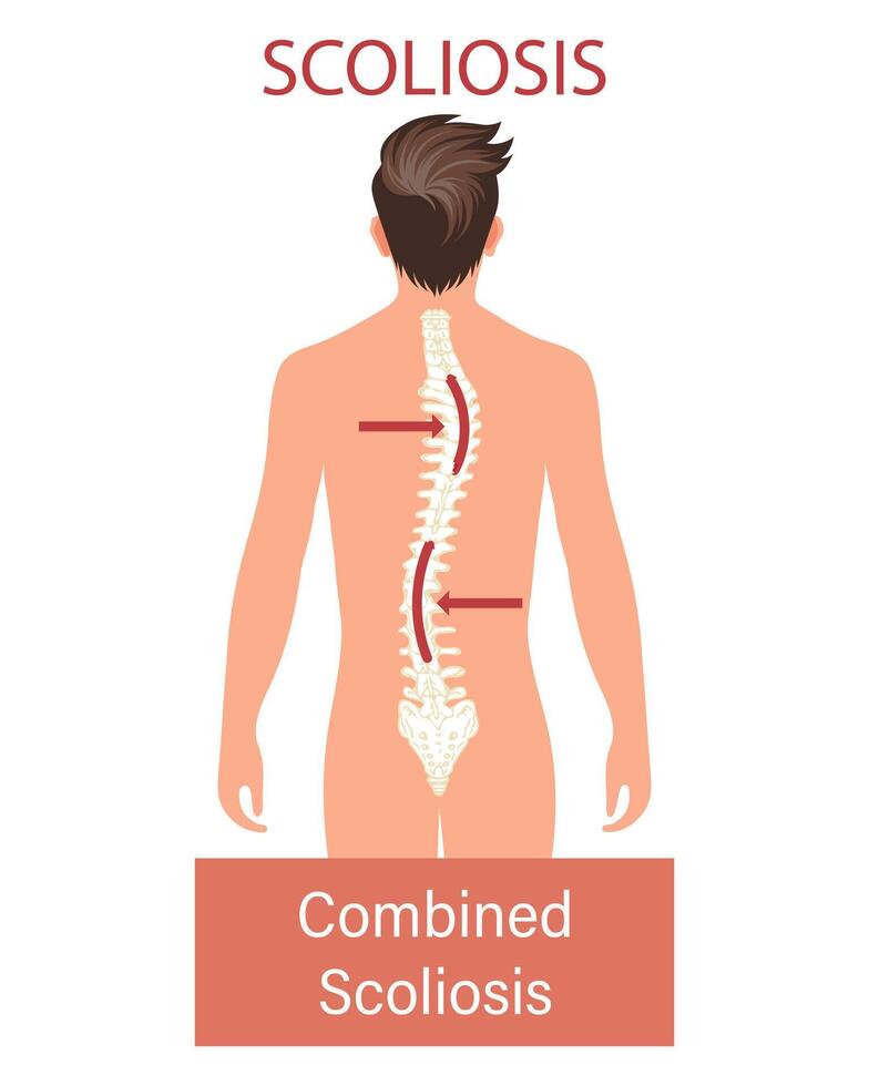 Scoliosis, a disease of the spine. Infographic banner with scoliosis of the human spine. Healthcare and medicine. Illustration vector