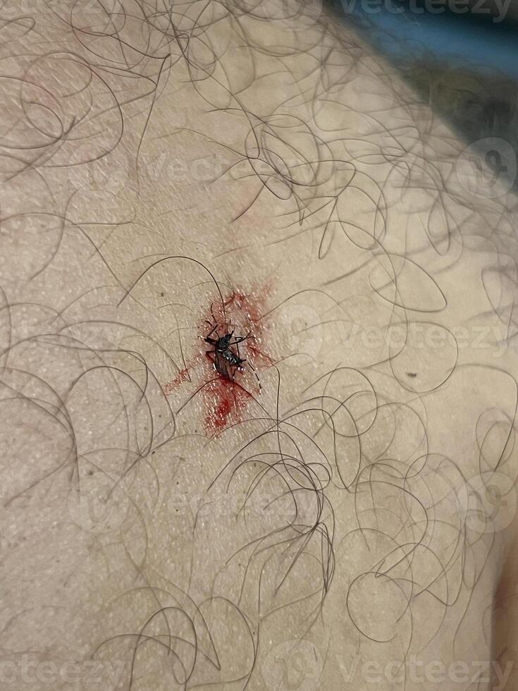 blood on the leg photo