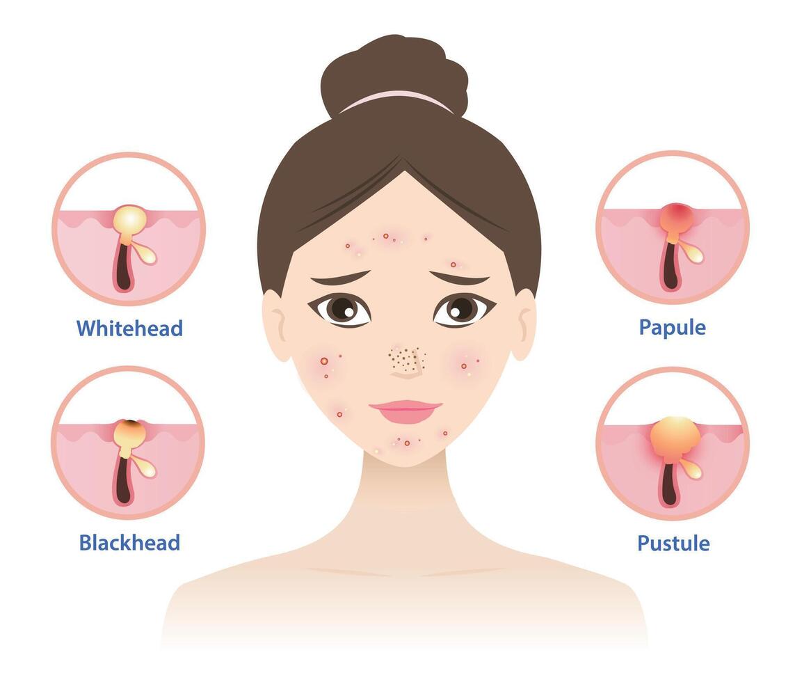 Types of acne on woman face illustration isolated on white background. Icon set of acne pimple, whitehead, blackhead, papule and pustule. Skin care and beauty concept. vector