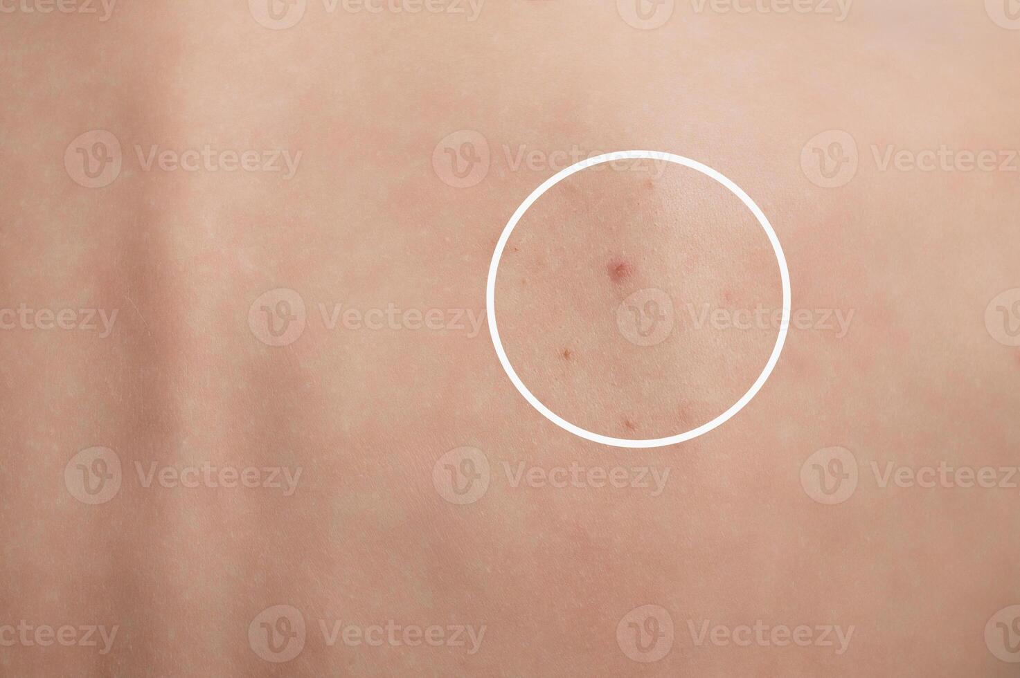 Close-up of the back skin of a woman with acne and other dermatological problems. photo