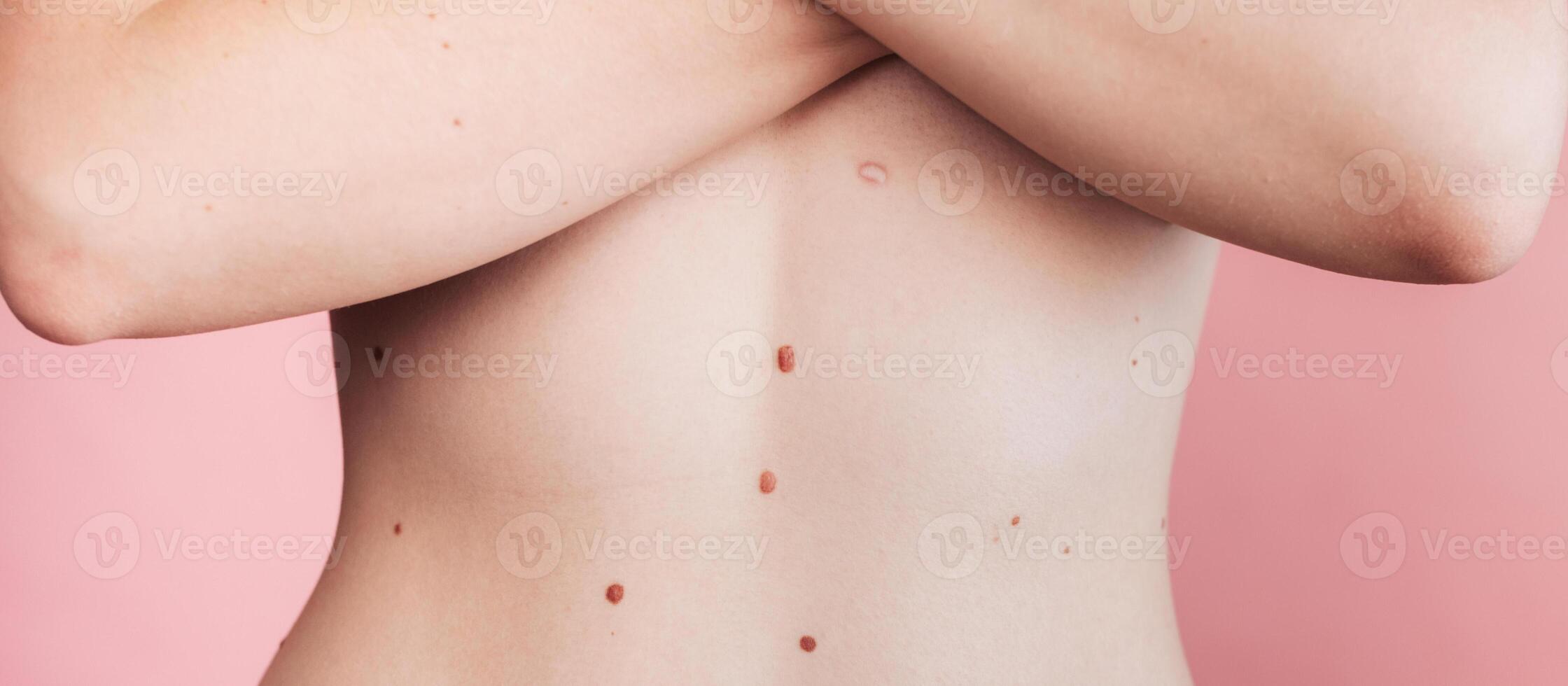 A woman's belly with numerous moles. The effect of the sun on the skin. Skin cancer. The panorama. photo