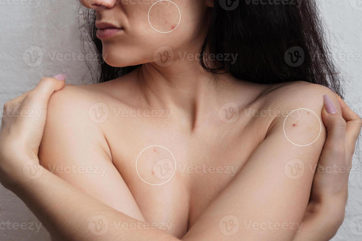 Close-up of the skin of the face and body of a woman with acne and other dermatological problems. photo