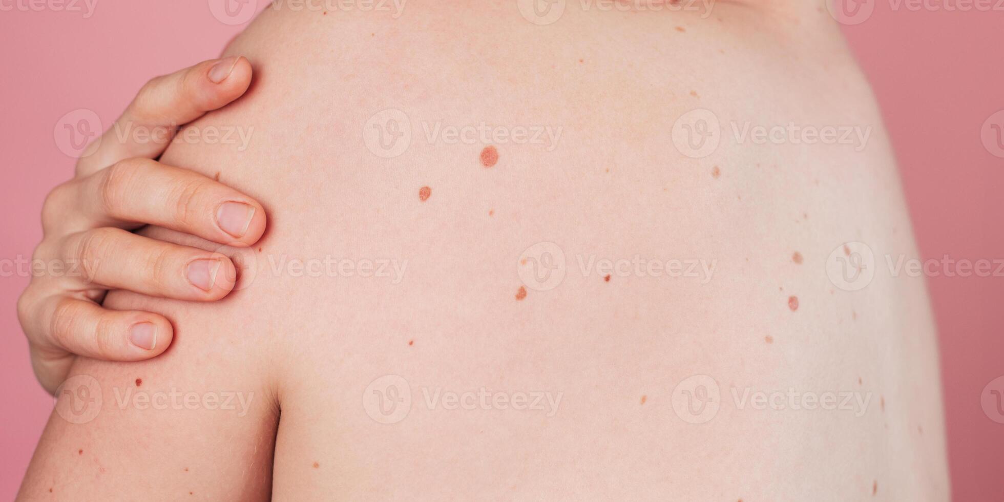 Close-up of a young woman's back with moles on the background. Without filters. Panoramic banner. photo