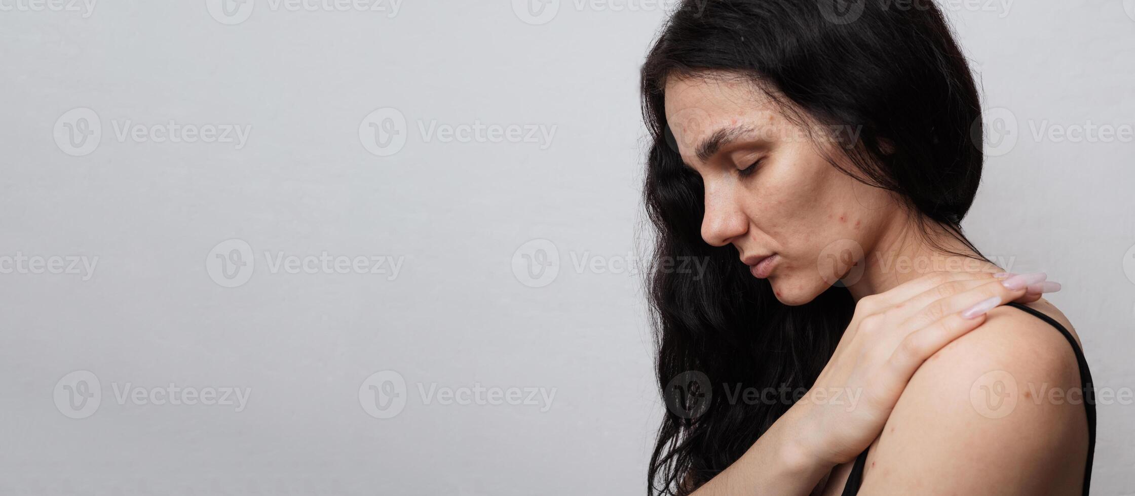 A large portrait of a young woman with skin problems - pimples, acne, enlarged pores. A place for your text. photo