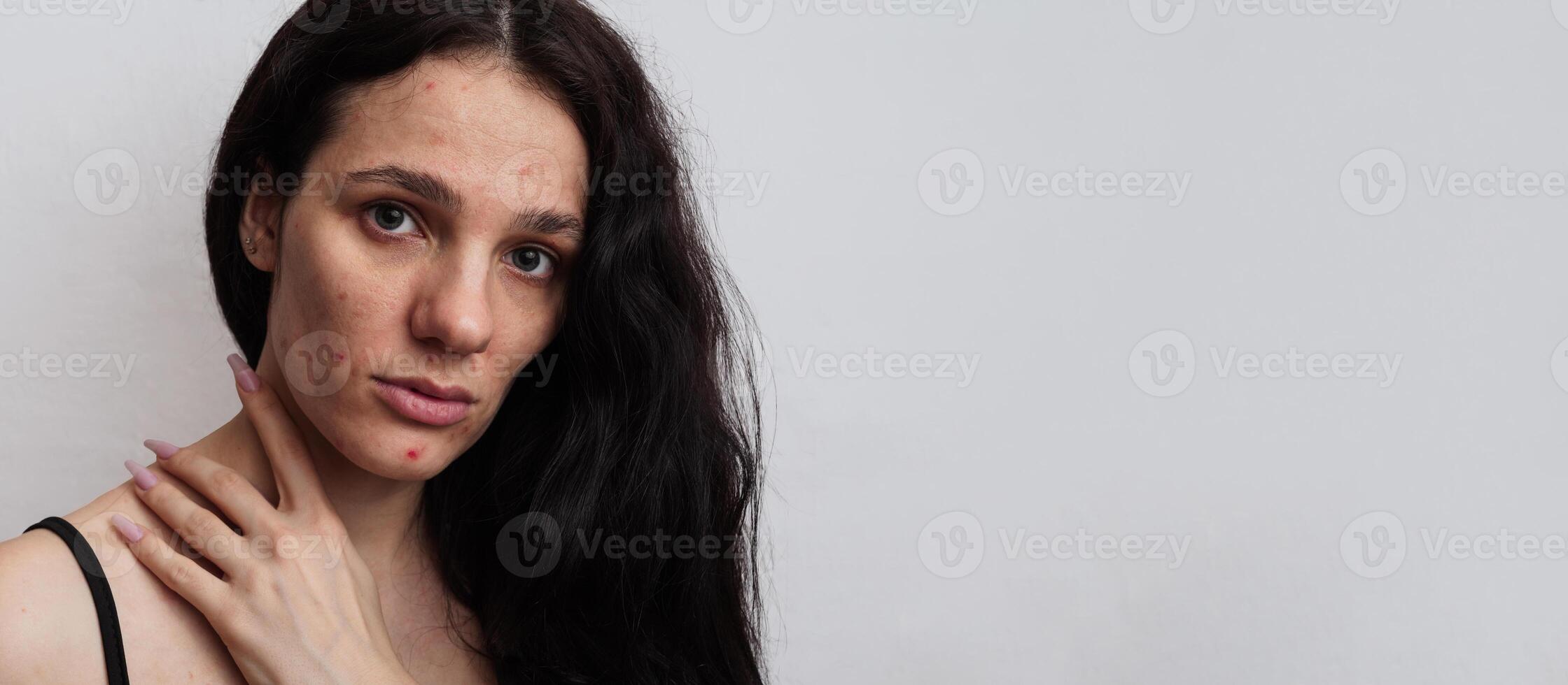 Close-up of a young woman with acne on her face and skin problems. A panoramic shot on the banner. a place for your text photo